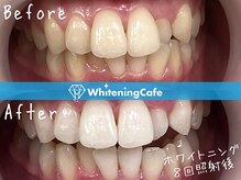 ホワイトニングカフェ 藤が丘店(WhiteningCafe)/ホワイトニングビフォーアフター
