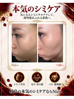 ニコ 岐南本店(Nico)の写真/結果重視Nico【本気のシミケア】シミだけじゃなく
くすみ、たるみ、毛穴、赤ら顔改善にも○
