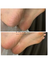 カーム(CALM)/ガサガサからフワフワへ