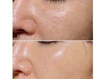 ルソール 銀座(Le seul)/毛穴ケアにおすすめ♪