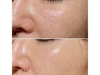 ルソール 銀座(Le seul)/毛穴ケアにおすすめ♪