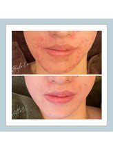 ラシュレ(BEAUTY CONCIERGE RASSURER)/ニキビ、赤み、凸凹にND-R！