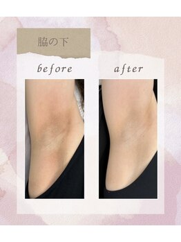 オンユ(ON’U)/【ローマピンク】脇のくすみ