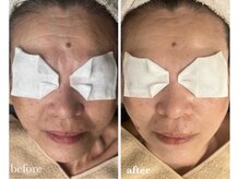 サロン ド ラム/【韓国PDTコース】4回目