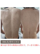 ティンクル サロン(Twinkle salon)/BBL光/背中ニキビケアで美肌