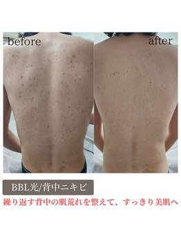 ティンクル サロン(Twinkle salon)/BBL光/背中ニキビケアで美肌