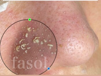 ファソ ブロウアンドアイズ(fasol)/毛穴洗浄コース