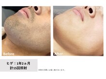 アーデル(Adel)の雰囲気（男性の濃いヒゲにも確実にアプローチ！青ヒゲ解消＊初回￥5,980）