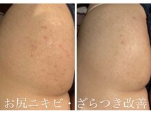 シャルム(CHARMER)/即！美尻ケアに！