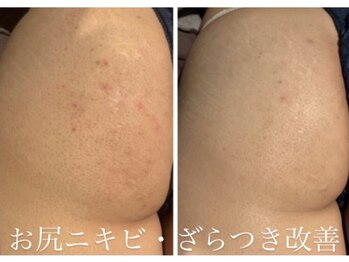 シャルム(CHARMER)/即！美尻ケアに！