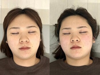ククナ 新横浜駅前サロン/小顔矯正ビフォーアフター　