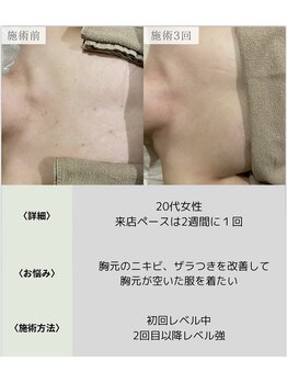 サロンエヌ 久留米店(Salon N)/デコルテ美人に◎