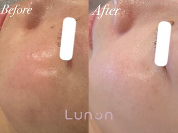 ルノン(Lunon)/毛穴洗浄ハイドロ×ララピール