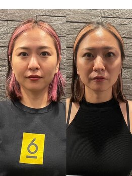 長寿鍼灸院 長寿整骨院/ハリネズミ女優美容鍼効果★