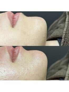 リリーブー 池袋(Lilyboo)/フェイシャルワックス