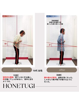 ほねつぎ総社 はりきゅう接骨院/成果/慢性腰痛