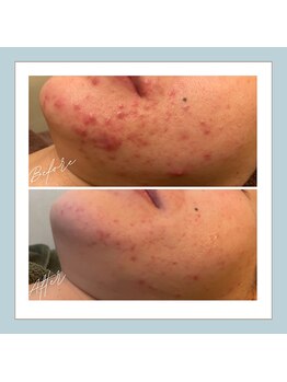 ラシュレ(BEAUTY CONCIERGE RASSURER)/ニキビ、赤み、凸凹にND-R！