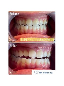 NA ホワイトニング 川崎溝の口店/ホワイトニング/川崎/溝の口