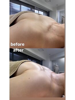 ルミエール(Lumiere)/【倉敷市】バストアップ施術事例