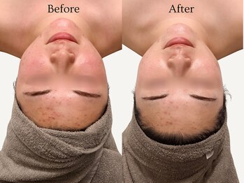 エミィ(emmy)/【肌質改善】施術1回でツヤ肌