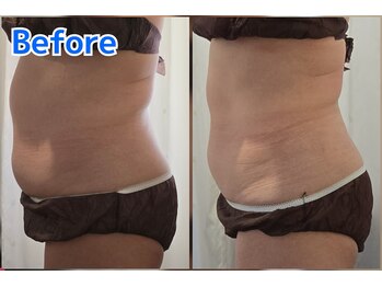 エステティック らぽーる(Rapport)/脂肪冷却ビフォーアフター