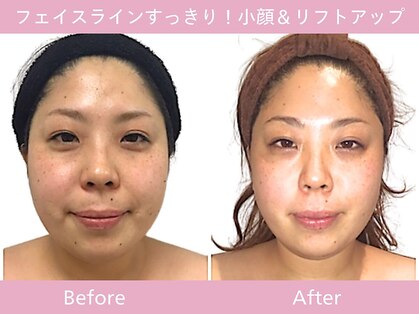 小顔フェイスラボ 神戸元町店(小顔 Face Labo.)の写真