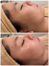 プレジール(PLAISIR)/ハーブピーリングBefore・After