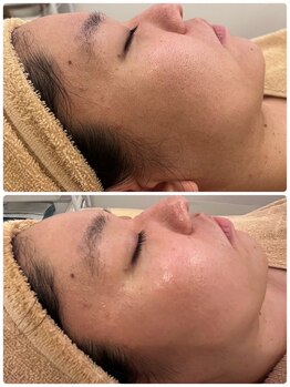 プレジール(PLAISIR)/ハーブピーリングBefore・After