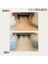ビテラス/うなじ脱毛