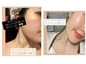 メリナ(Melina)/ニキビケア/コメド/首のシワ改善