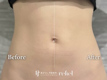 リフィール たまプラーザ店(refiel)/1回で実感♪美くびれライン！