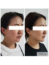 エステサロン ベルジュール/リフトアップ