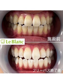 ルブラン 奈良店(Le Blanc)/黄ばみ気になっていませんか?