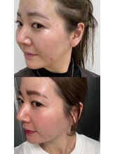 スペース(spAce)/ツヤ肌ピーリング