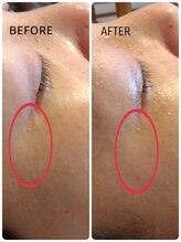 リル(RIRE)/プラズマエステ