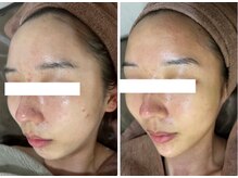 ホワイトアクア 四日市店(WHITE AQUA)/ルヴィハーブピーリング四日市