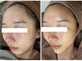 ホワイトアクア 四日市店(WHITE AQUA)/ルヴィハーブピーリング四日市