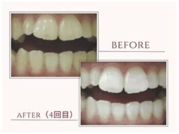 ラディアンス(Radiance+)/ 富山市メンズ◎ホワイトニング