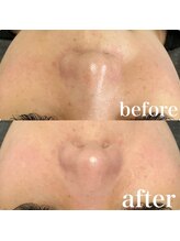 エードット スパ アンド ハーブ(a.spa & herb)/ハーブピーリング