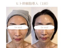 ルソール(Le seul)の雰囲気（1度でこの効果！ヒト幹細胞原液導入で水光肌。インディバ/美容鍼）