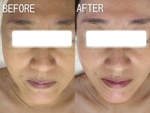 イエローウィーン(YELLOWEEN.)/ハーブピーリング