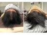 【育毛促進鍼】男性:抜け毛|分け目対策スカルプ鍼18,700→16,000