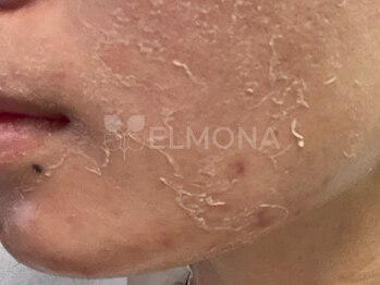 グリーンピール エルモナ(GREENPEEL ELMONA)/【グリーンピール5Days】シェド