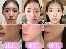 パール 四条大宮(Pearl)の雰囲気（【すぐ結果が出る】表情筋を鍛えて小顔NEWメニュー/テラボーラー）