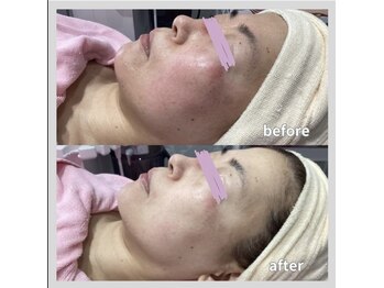 じゅえる/→続き シミケアエステの効果