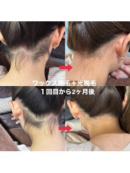 エンジェルワックス 新宿店(Angel Wax)/ダブル脱毛は1ヶ月後も綺麗♪