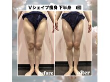 ルピナス ヒサヤ(LUPINUS hisaya)/Vシェイプ痩身