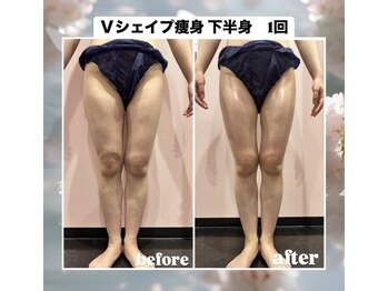 ルピナス ヒサヤ(LUPINUS hisaya)/Vシェイプ痩身