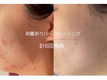 ヒジ(Life Salon)/ハーブピーリング/毛穴洗浄