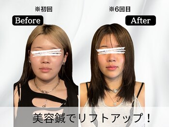 ハリユナイテッド 原宿鍼灸 整体院(HALI UNITED)/美容鍼でリフトアップ!